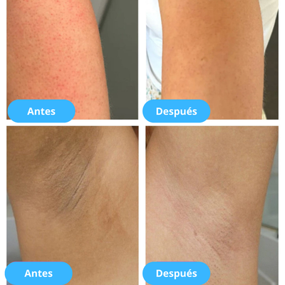 Plenia™ Peel Shot - Exfoliante Corporal Aclarante | 1+1 GRATIS