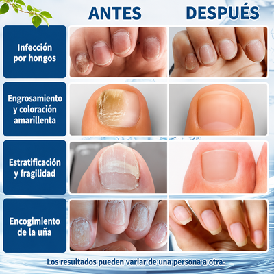 Plenia™ Fungus - Solución contra Hongos para unas uñas perfectas