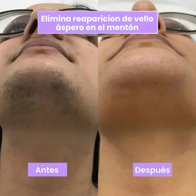Plenia Hair™ | El Spray Revolucionario que frena el vello