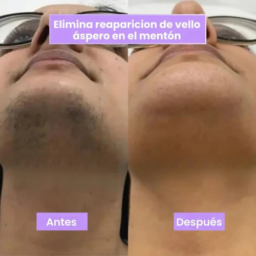 Plenia Hair™ | El Spray Revolucionario que frena el vello